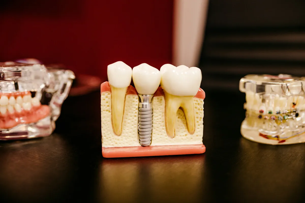 Implant dentar în Iași: ghid complet pentru pacienți