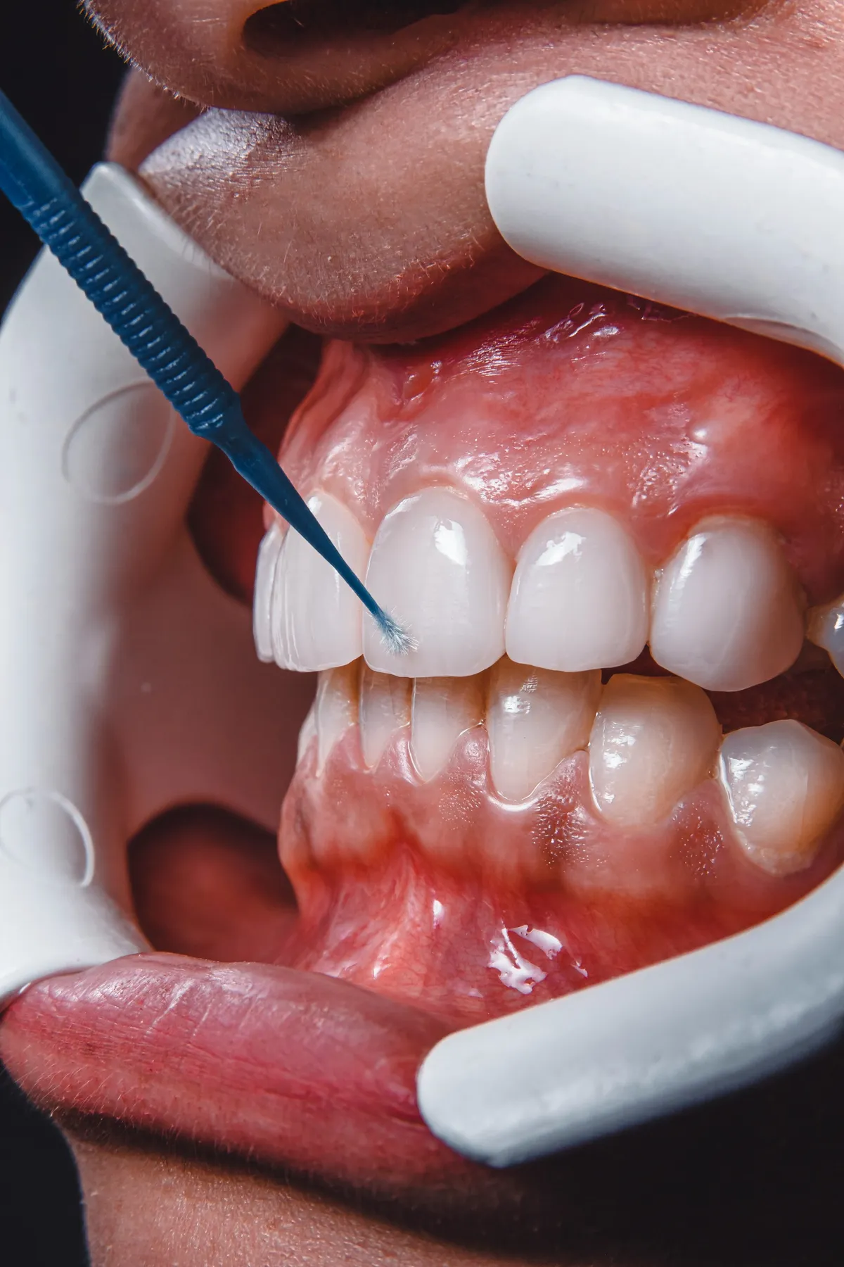 Igienizarea dentară profesională: de ce și cât de des
